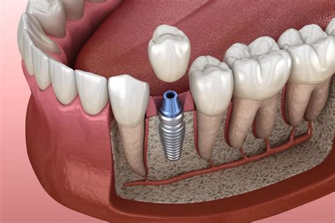 En qué consiste la osteointegración de los implantes dentales
