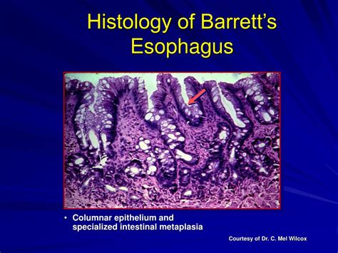 Ppt Barretts Esophagus Clinical Aspects Importance And Controversies