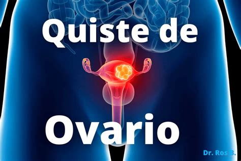 Quistes De Ovario Diagnóstico Y Tratamiento Dr Ros Berruezo