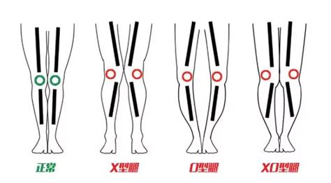 How Do You Know Which Leg Type You Are Eva Orthotic Insoles