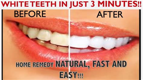 White Teeth In Just 3 Minutes At Home Naturally And Fast Youtube