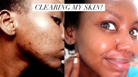 Clearing My Skin I Tried The 10 Step Korean Skin Care Routine