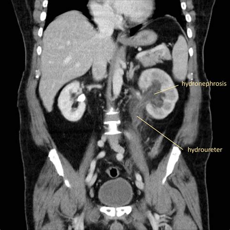 Renal Pathology Radiology Cafe