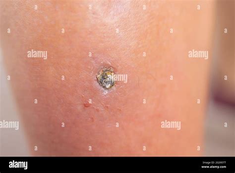 Pimple Folliculitis On Buttock Caused By Infection From Bacteria Yeast