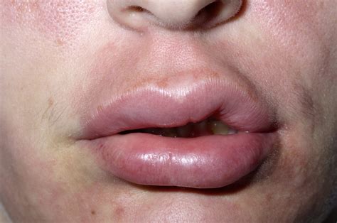 Lip Biting Meaning Causes Symptoms Images Bumps Swollen Lip From Biting And Treatment