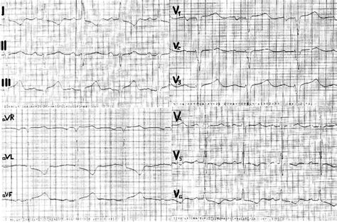 Predominant Severe Right Ventricular Outflow Tract Obstruction In
