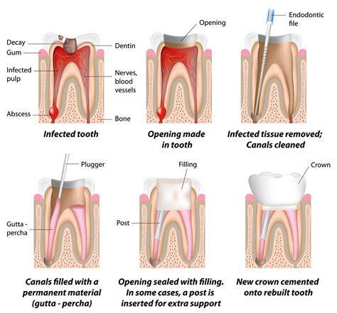Root Canal A Complete Guide To Treatment And Procedures