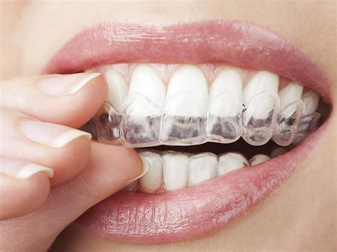 Cosmetic Dental Treatments In Scotland Clyde Munro