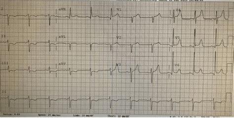 Dextrocardia Can You Pick It On Ecg Resus