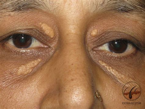 What Is Xanthelasma Dermacosm