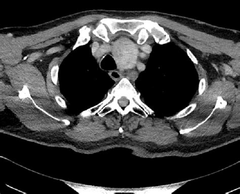 Axial Ct Image Showing The Thoracic Duct Cyst Download Scientific