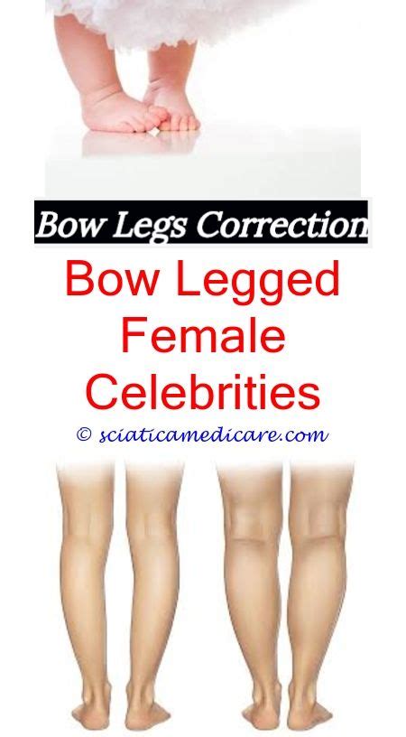 Find knee replacement on topsearch.co. Bow Legged Toddler | Bow legged, Bow legged correction ...