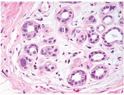 Pathology Of Benign Breast Disorders Oncohema Key