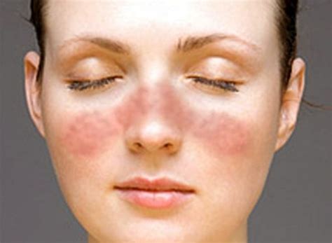 👉 Lupus Rash Pictures Symptoms Causes Treatment December 2021