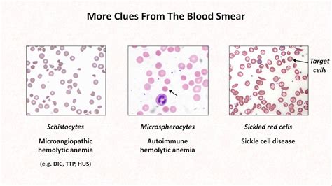 Peripheral Blood Smear Showing Schistocytes And Decreased Platelets