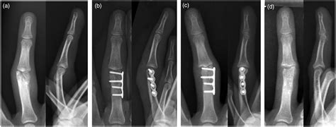 Corrective Osteotomy For Distal Condylar Malunion Of The Proximal