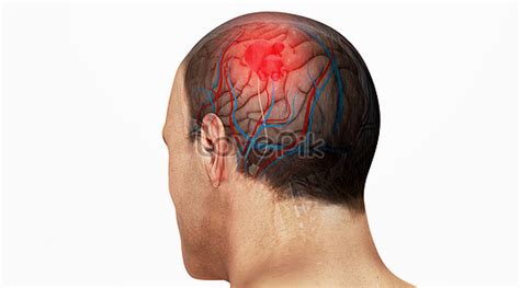 Brain Diseases Images Hd Pictures For Free Vectors Psd Download Lovepik Com