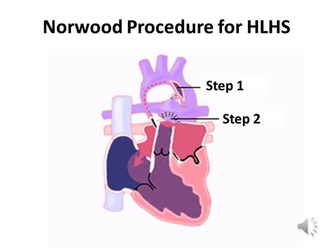 Norwood Procedure For Hypoplastic Left Heart Syndrome Youtube