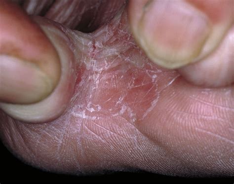 Fußpilz Symptome Ursachen Und Behandlung