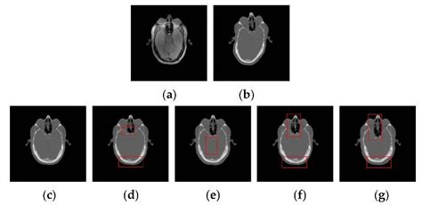 Ct Mr Image Registration Results For The Psr Mind Essd Wld And Nmi