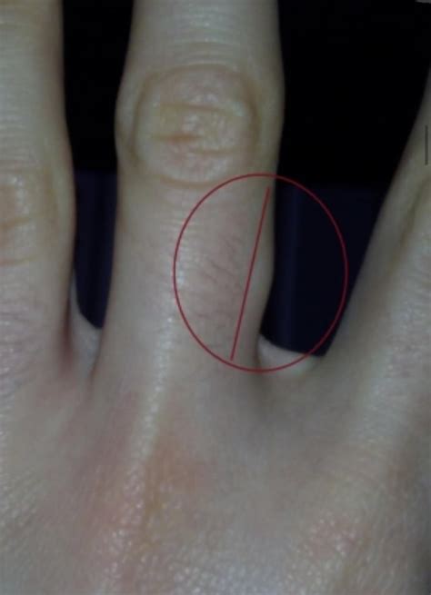 What Can Be This Painless And Hard Lump On Finger Rdermatologyquestions
