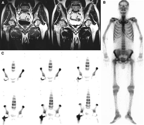 Bone Spect Is More Sensitive Than Mri In The Detection Of Early