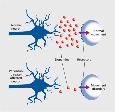 Parkinson νόσος Α Καργάδου Νευρολόγος