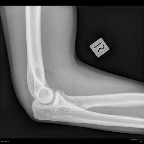 Radial Head Fracture Core Em