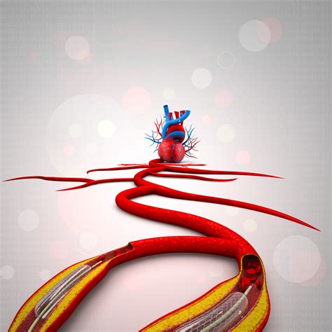 Stent Angioplasty Procedure With Placing A Balloon Cardiopapers