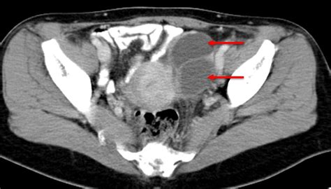 Endometriotic Cyst Radiology Cases