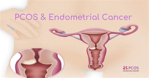 In other words, the rate of exposure to h. PCOS and Endometrial Cancer: What Women Need to Know ...