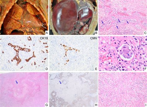 Extrahepatic Biliary Atresia In A Premature Neonate With Congenital Cytomegalovirus Infection