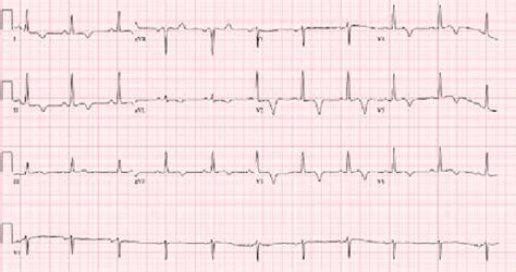 Ekg Showing Normal Sinus Rhythm With T Wave Abnormality And Prolonged