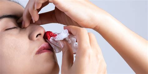 How To Stop A Nosebleed In As Little As 5 Minutes