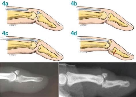 Aspetar Sports Medicine Journal Bony Avulsion In Long Fingers