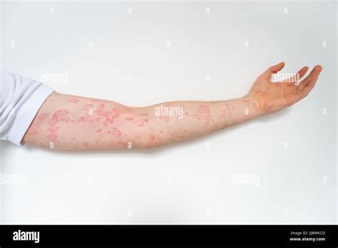 Photograph Showing A Mans Arm With Chronic Urticaria Or Hives A Rash