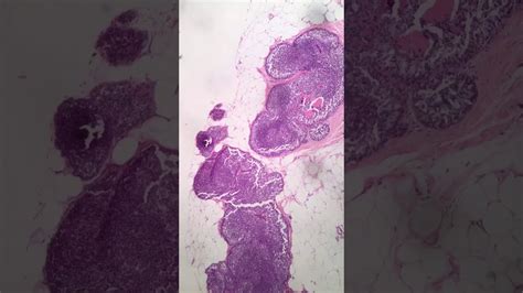 Microcalcifications May Lead To Early Detection Of Breast Cancer Youtube