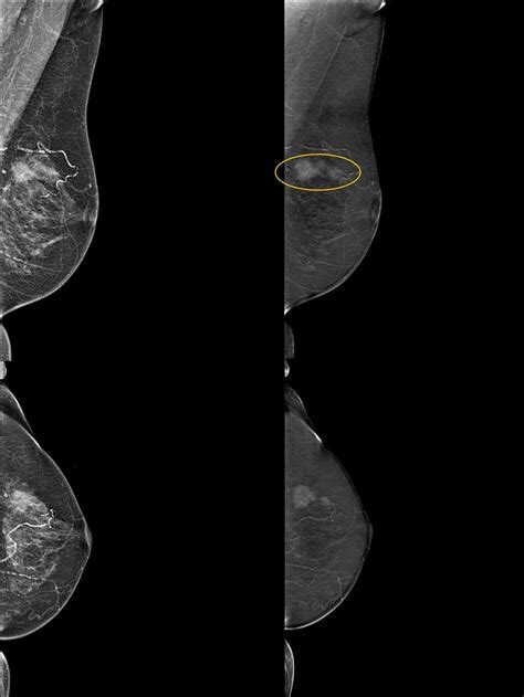 Tomosynthesis And Contrast Enhanced Mammography Improve Cancer Detection