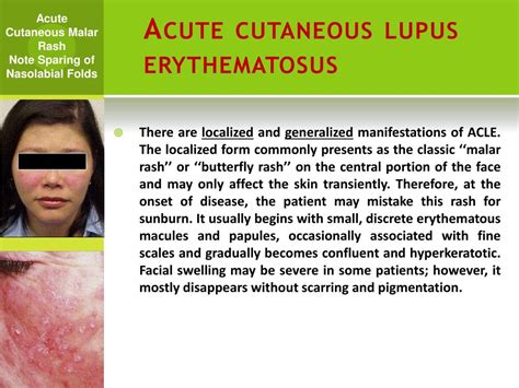 Ppt Mucocutaneous Involvement In Systemic Lupus Erythematosus