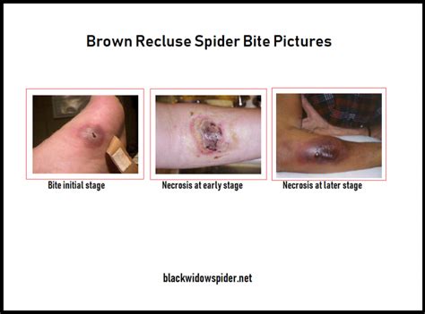Brown Recluse Spider Bite Treatment Stagespicturesimages