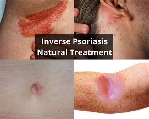 Inverse Psoriasis Natural Treatment Psoriasis Self Management