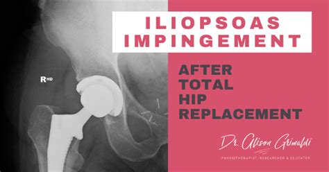 Iliopsoas Tendonitis After Hip Replacement Doctorvisit
