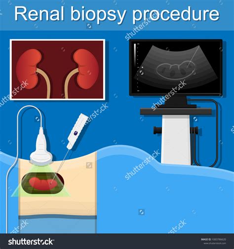 Renal Biopsy Procedure Kidney Tissue Lab Stock Vector Royalty Free