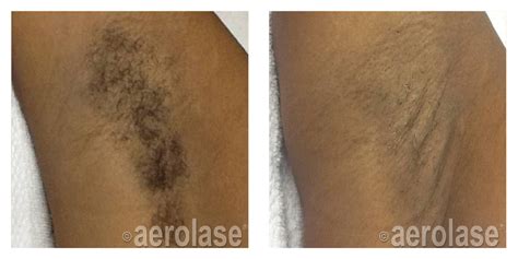Maybe you would like to learn more about one of these? Small Area Laser Hair Removal Portland, OR | RediMedi ...