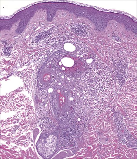 Pathology Outlines Eosinophilic Pustular Folliculitis