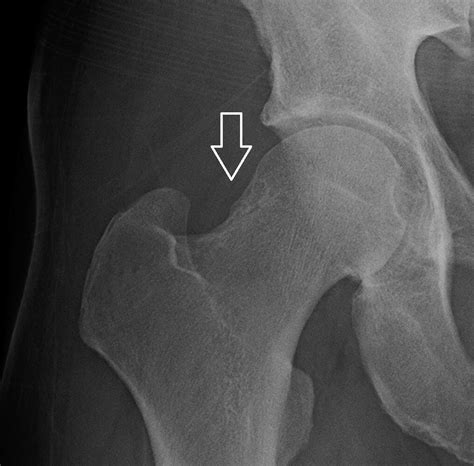 Orthodx Lesion On The Femoral Headneck Junction Clinical Advisor