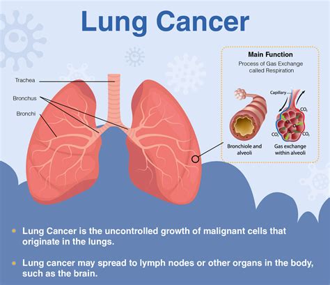 Overview Of Lung Cancer Signs Symptoms Diagnosis Treatment