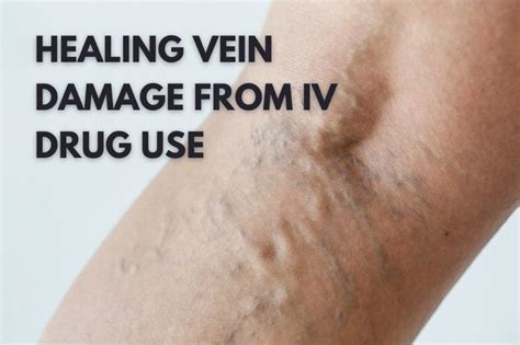 How To Support Healing Vein Damage From Iv Drug Use