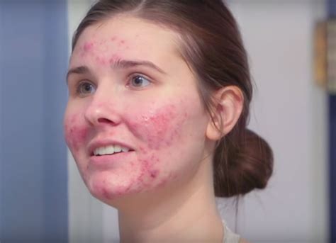 Woman With Severe Cystic Acne Has Finally Shared Her Barefaced Pictures