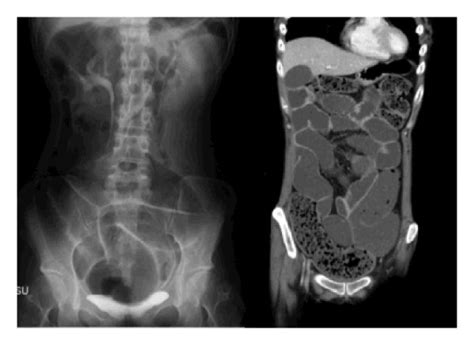 Abdominal Radiography And Ct Findings At The Emergent Admission A And